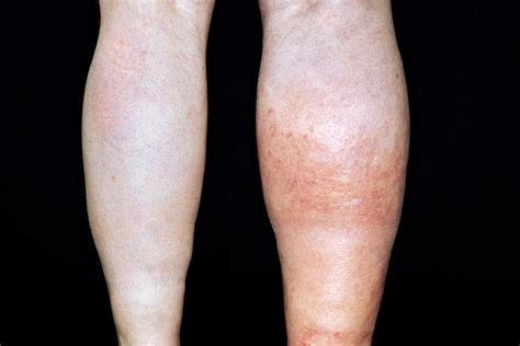Blood Clot (DVT): Symptoms in Legs, Lungs, heart, arm and .